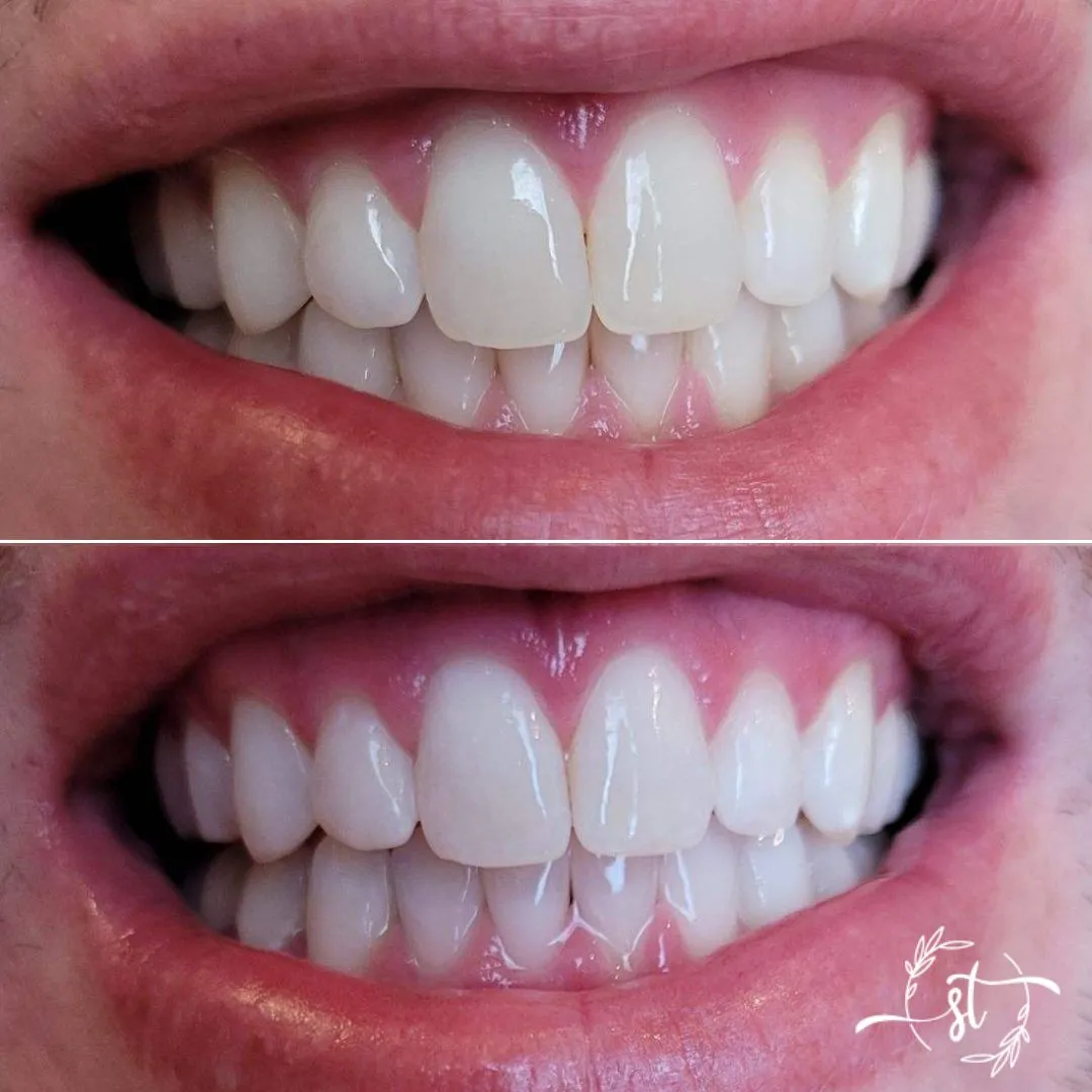 Before and after — smile case 1