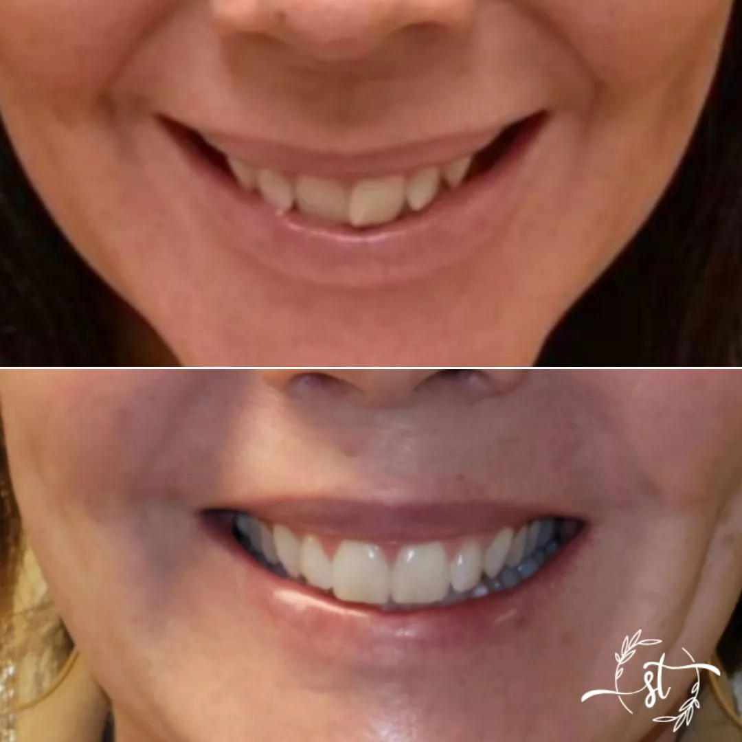 Before and after — smile case 2