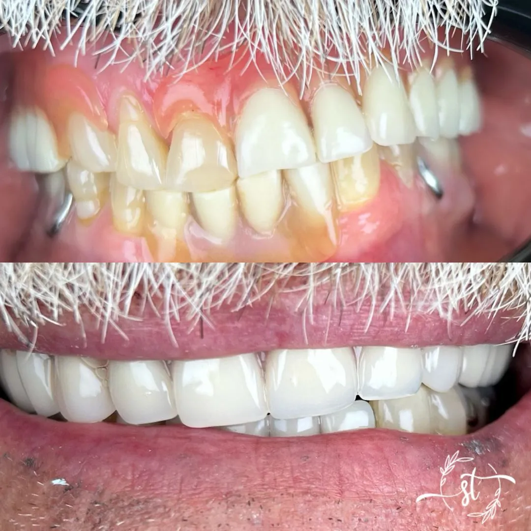 Before and after — smile case 3