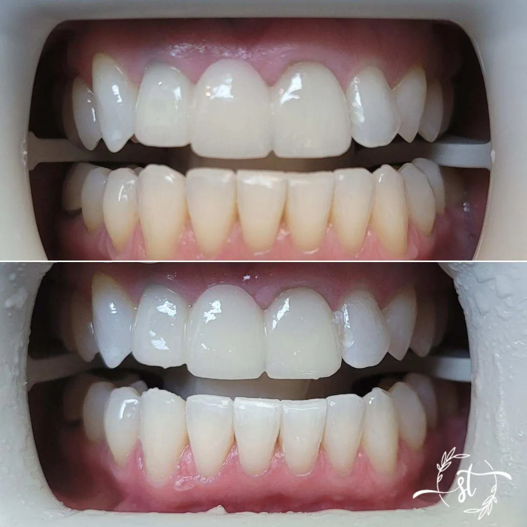 Before and after — smile case 4