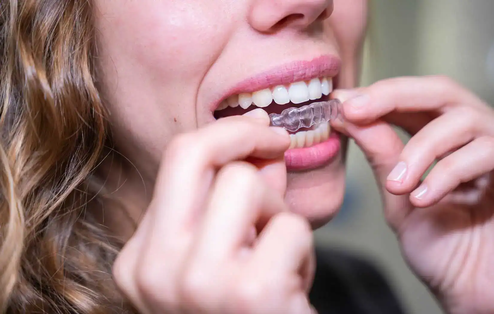 What Happens if Your Teen Loses Their Invisalign Aligners in Tustin?