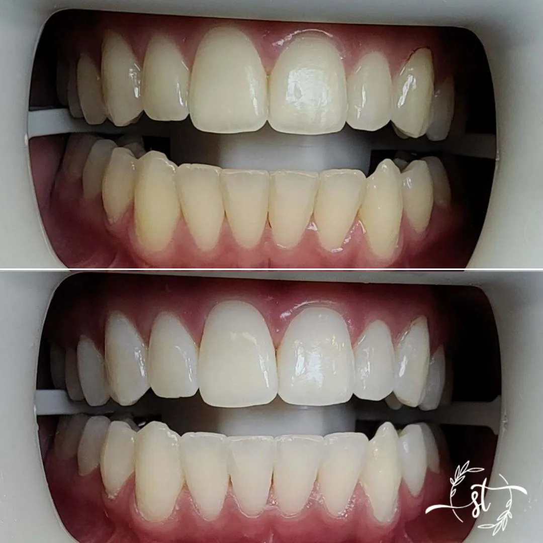 Before and after — smile case 5