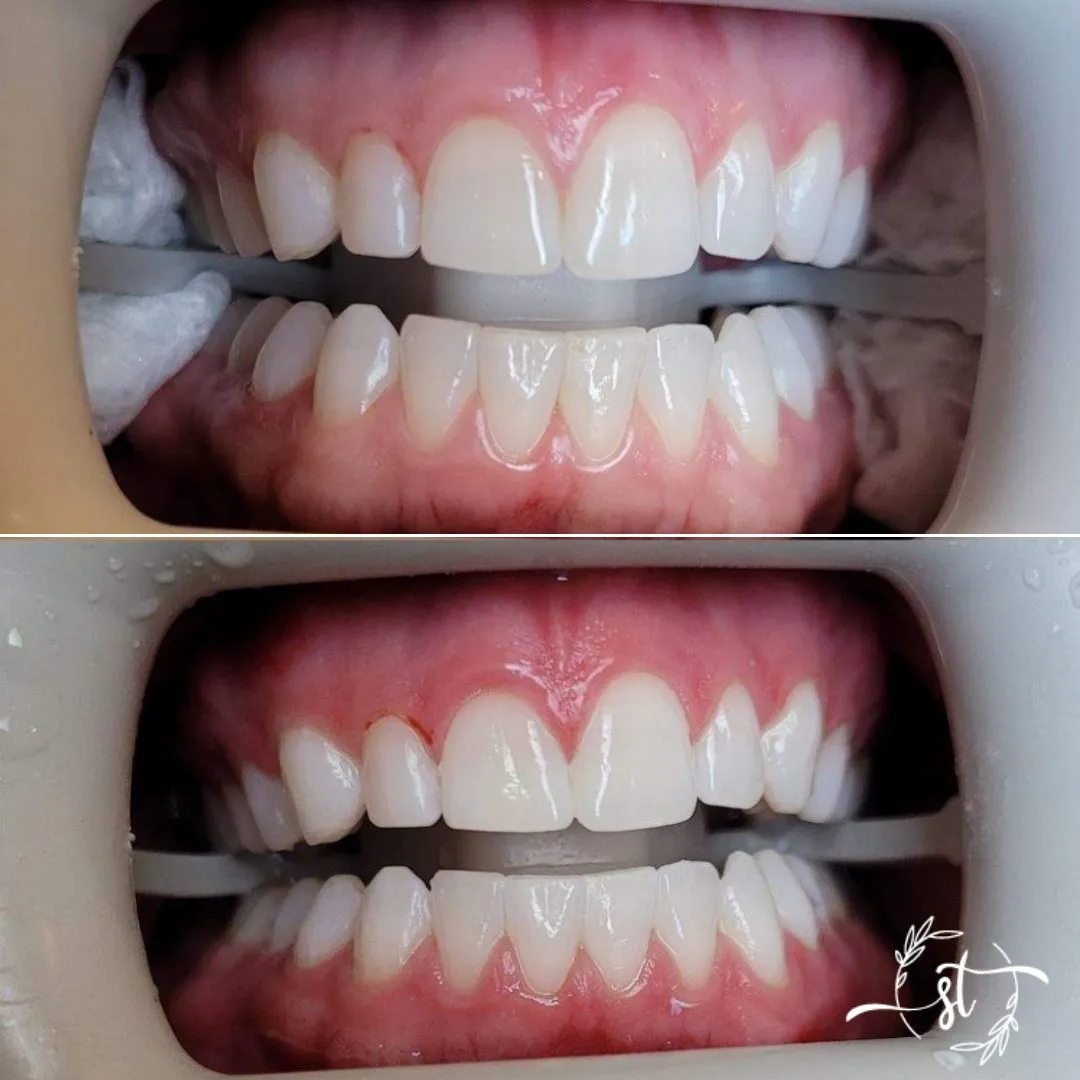 Before and after — smile case 6