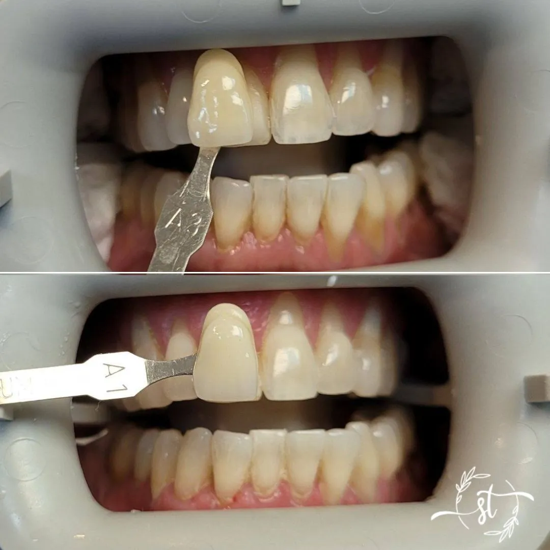 Before and after — smile case 8
