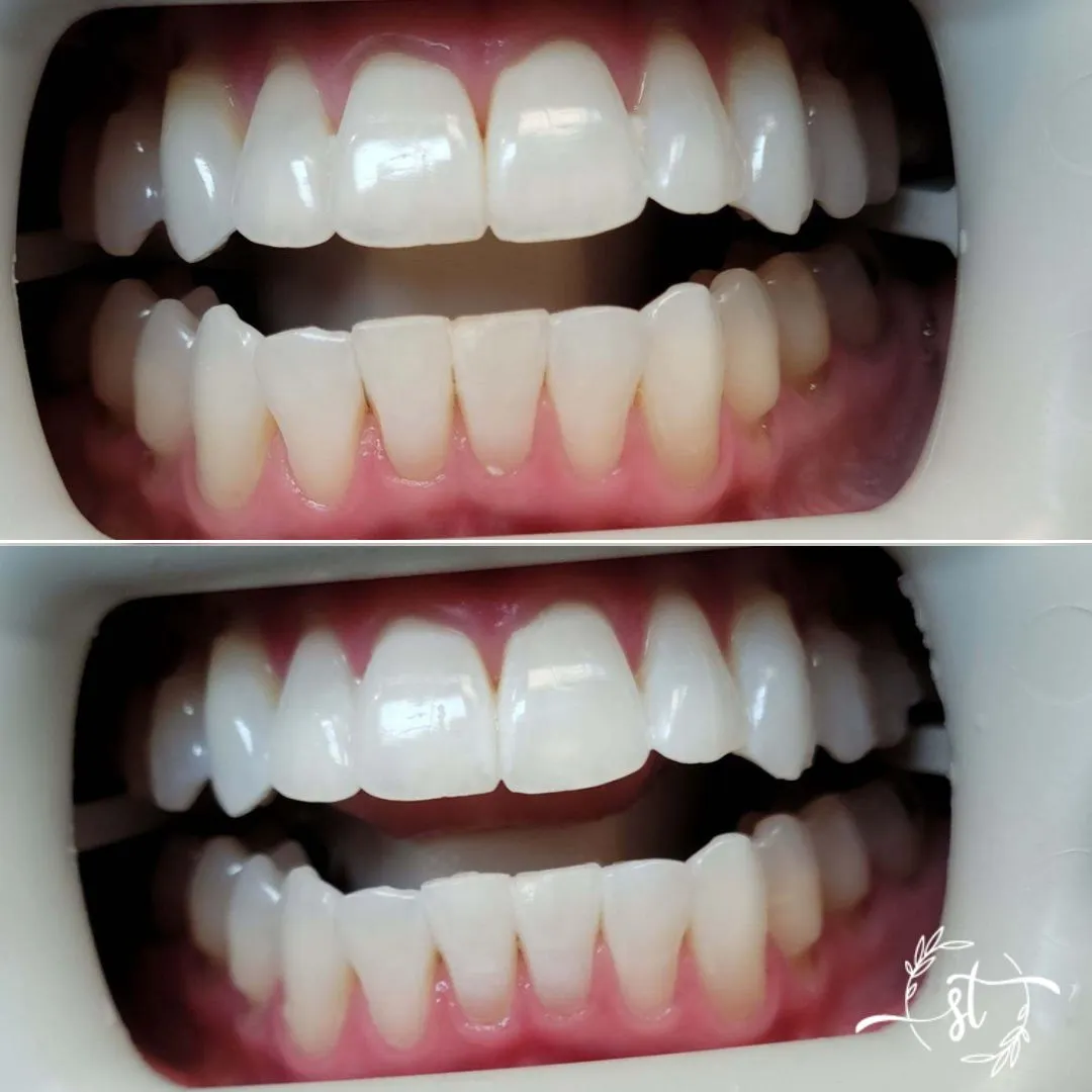 Before and after — smile case 7