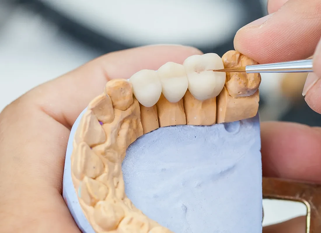 Dental Bridges in Tustin, CA