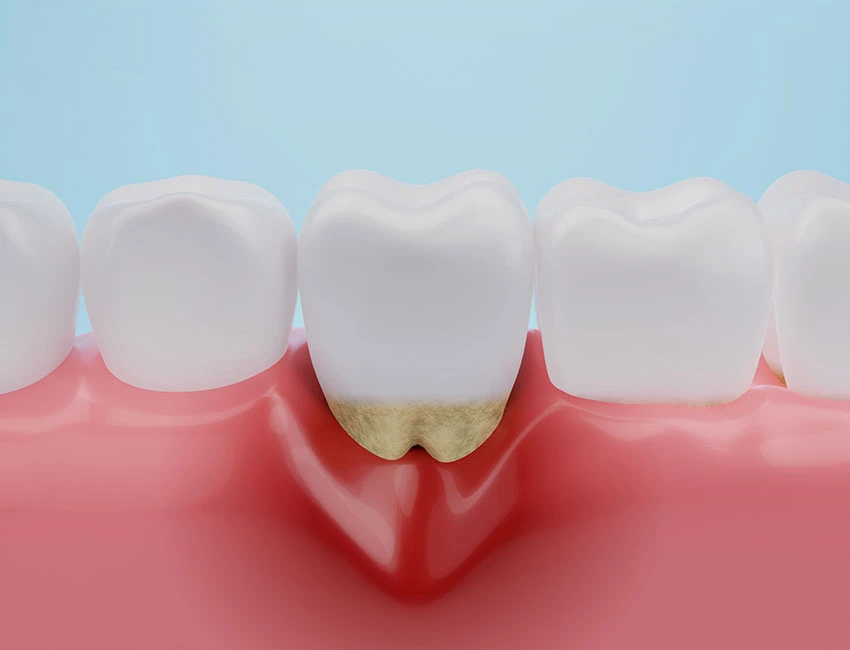Periodontal Care at Smile Tustin by Dr. Ezzy