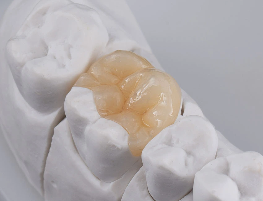 Signs you may need inlays and onlays — Smile Tustin by Dr. Ezzy