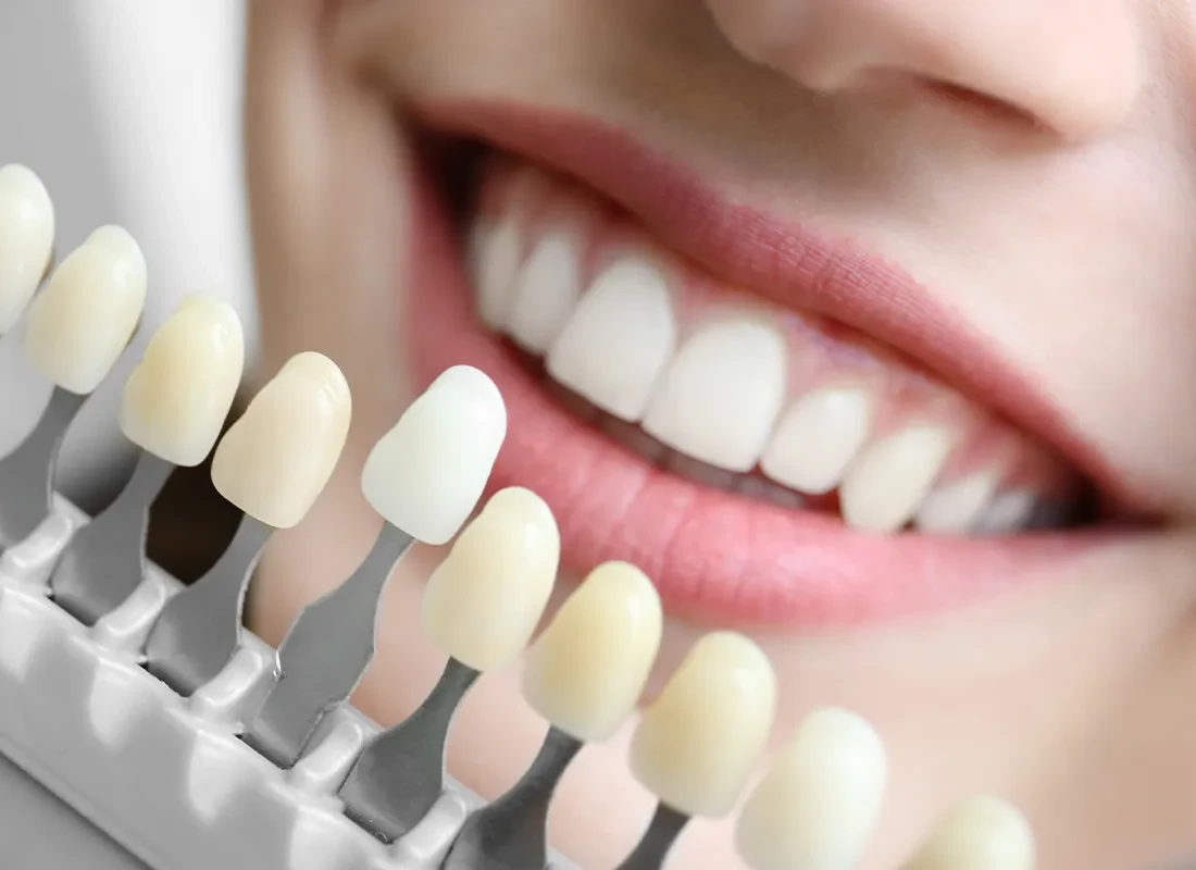 Internal Bleaching at Smile Tustin by Dr. Ezzy