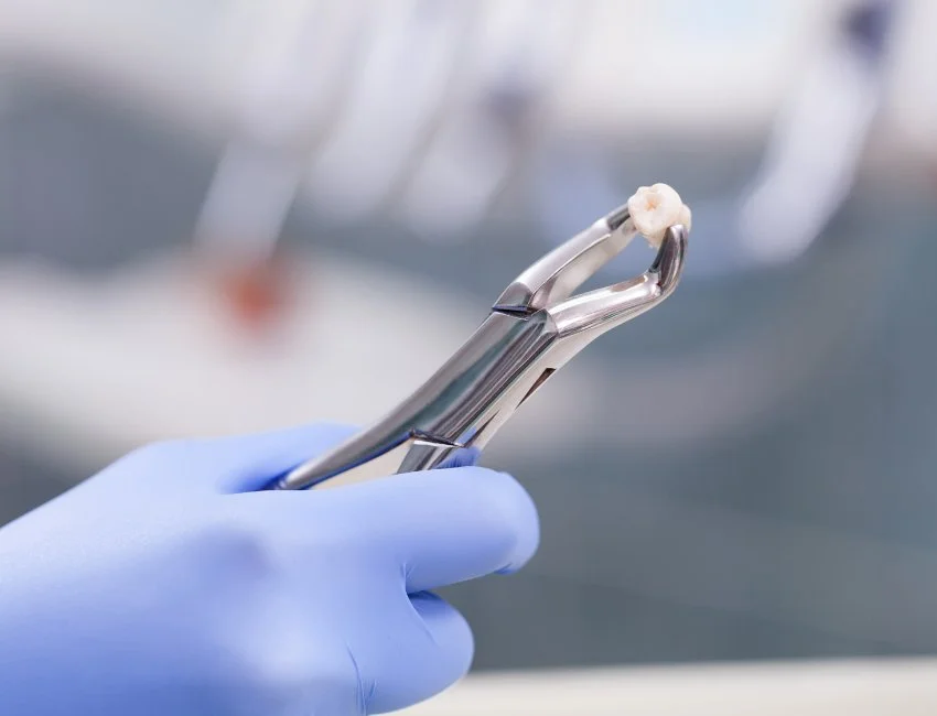 Signs you may need simple and surgical extractions — Smile Tustin by Dr. Ezzy