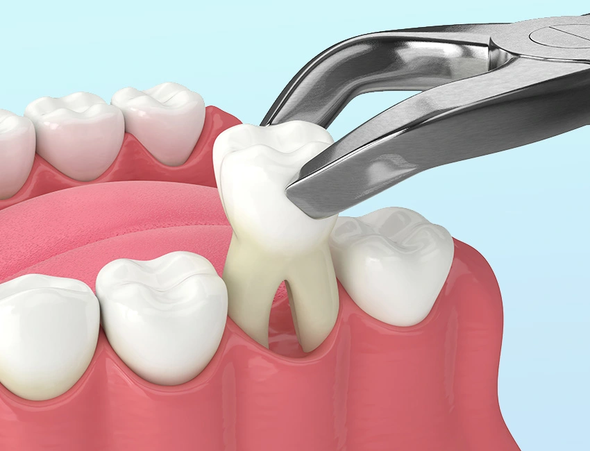 Simple and Surgical Extractions at Smile Tustin by Dr. Ezzy