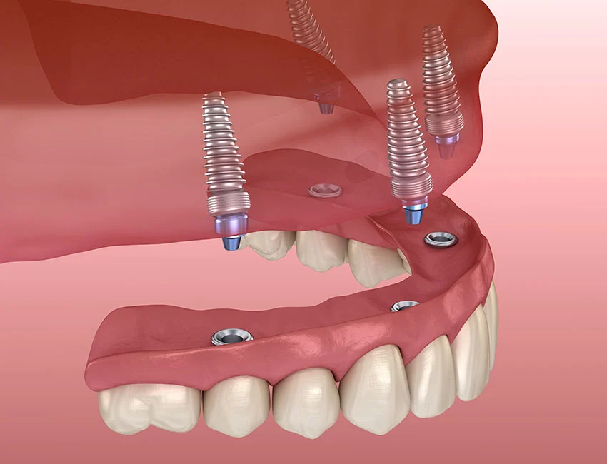 All-on-4 Dental Implants at Smile Tustin by Dr. Ezzy