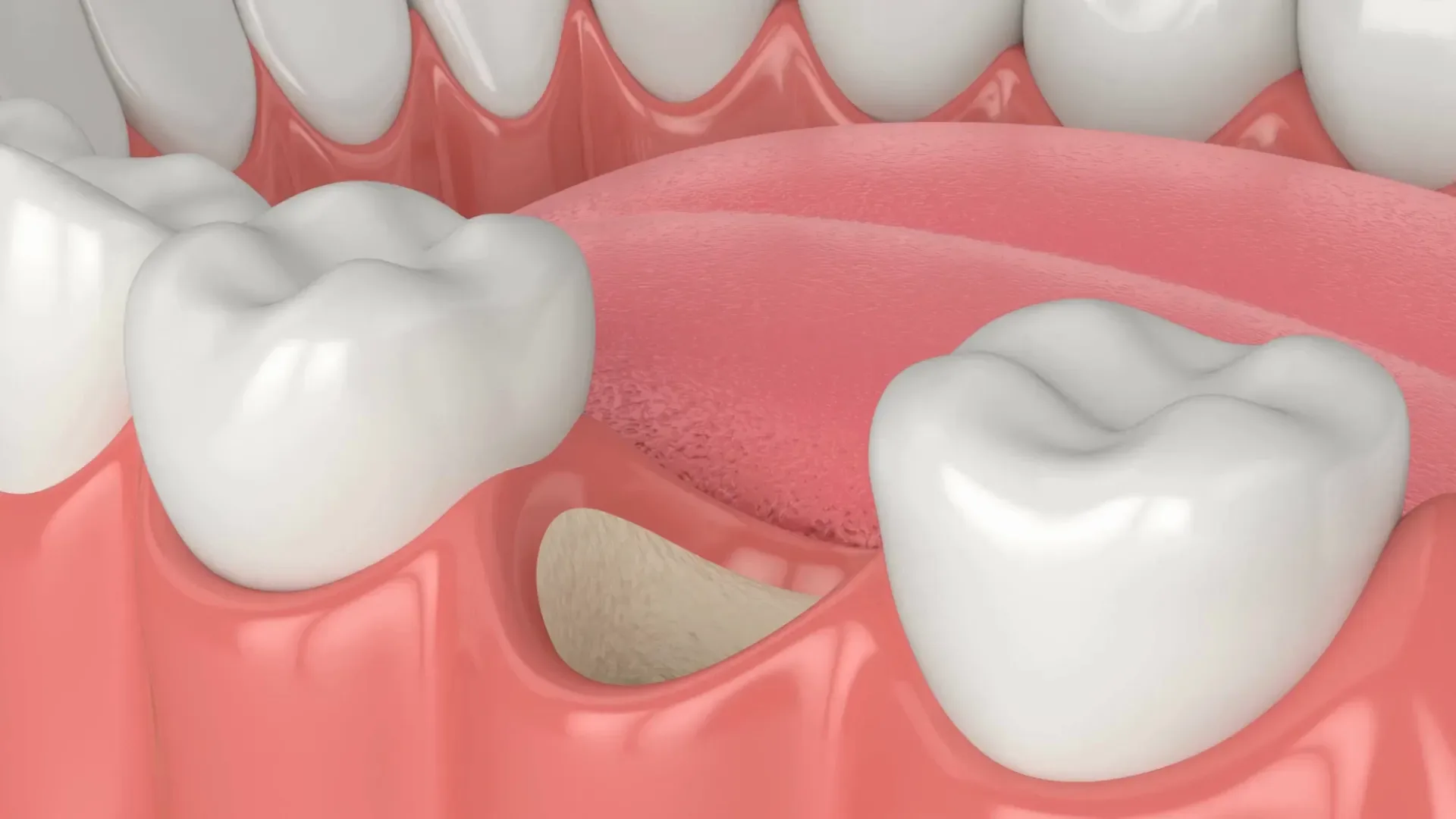 Bone Grafting at Smile Tustin by Dr. Ezzy