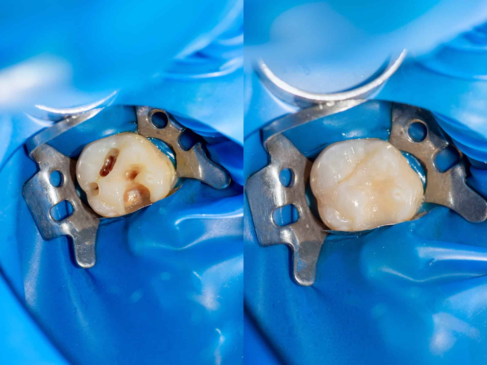 before and after cavity