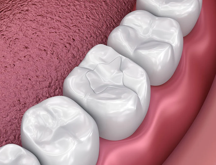 Signs you may need composite fillings — Smile Tustin by Dr. Ezzy