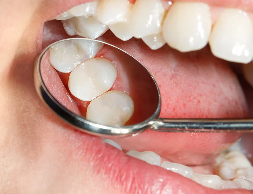 Composite Fillings at Smile Tustin by Dr. Ezzy
