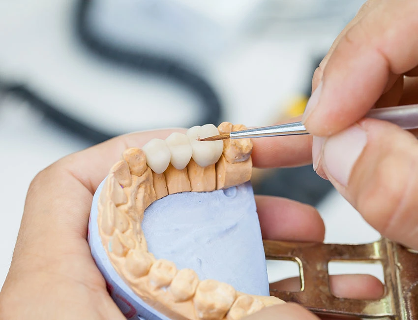 Signs you may need dental bridges — Smile Tustin by Dr. Ezzy
