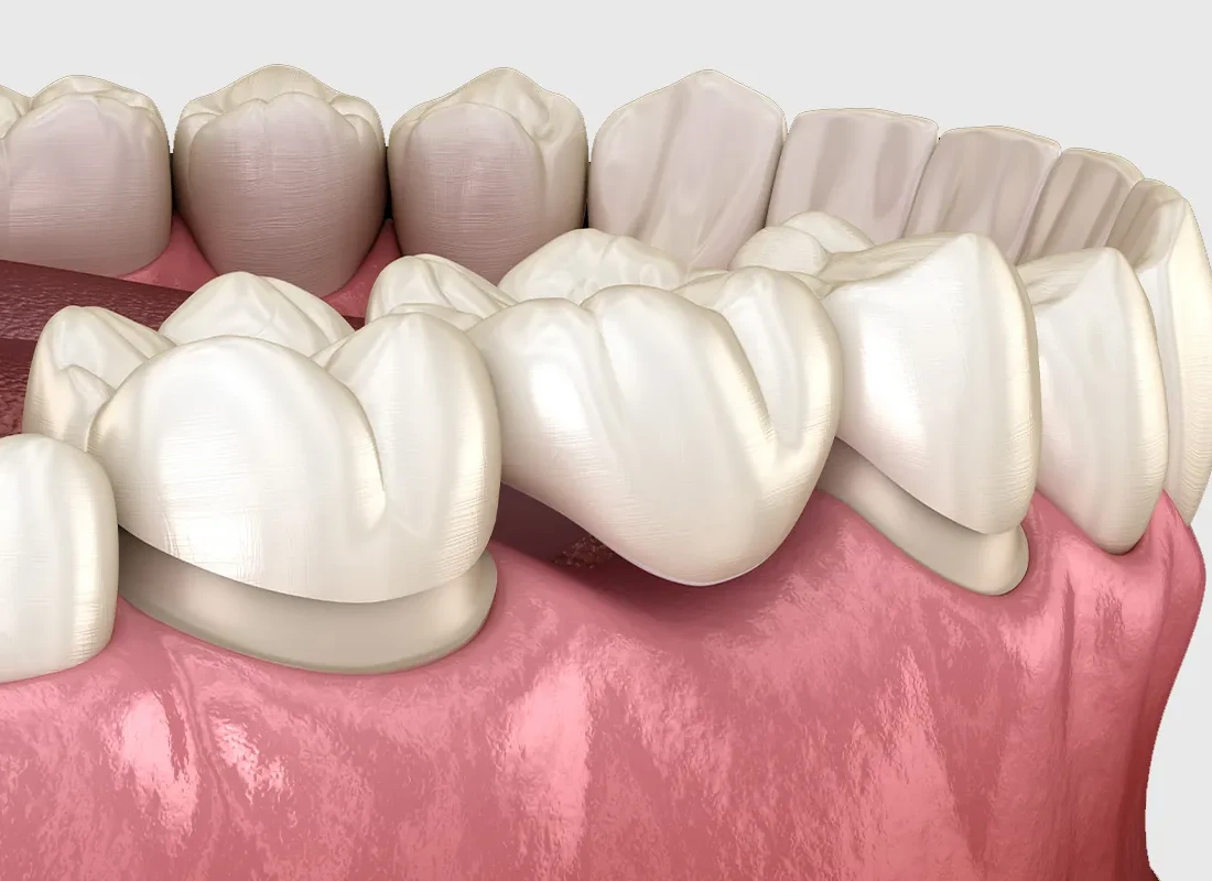 Dental Bridges at Smile Tustin by Dr. Ezzy