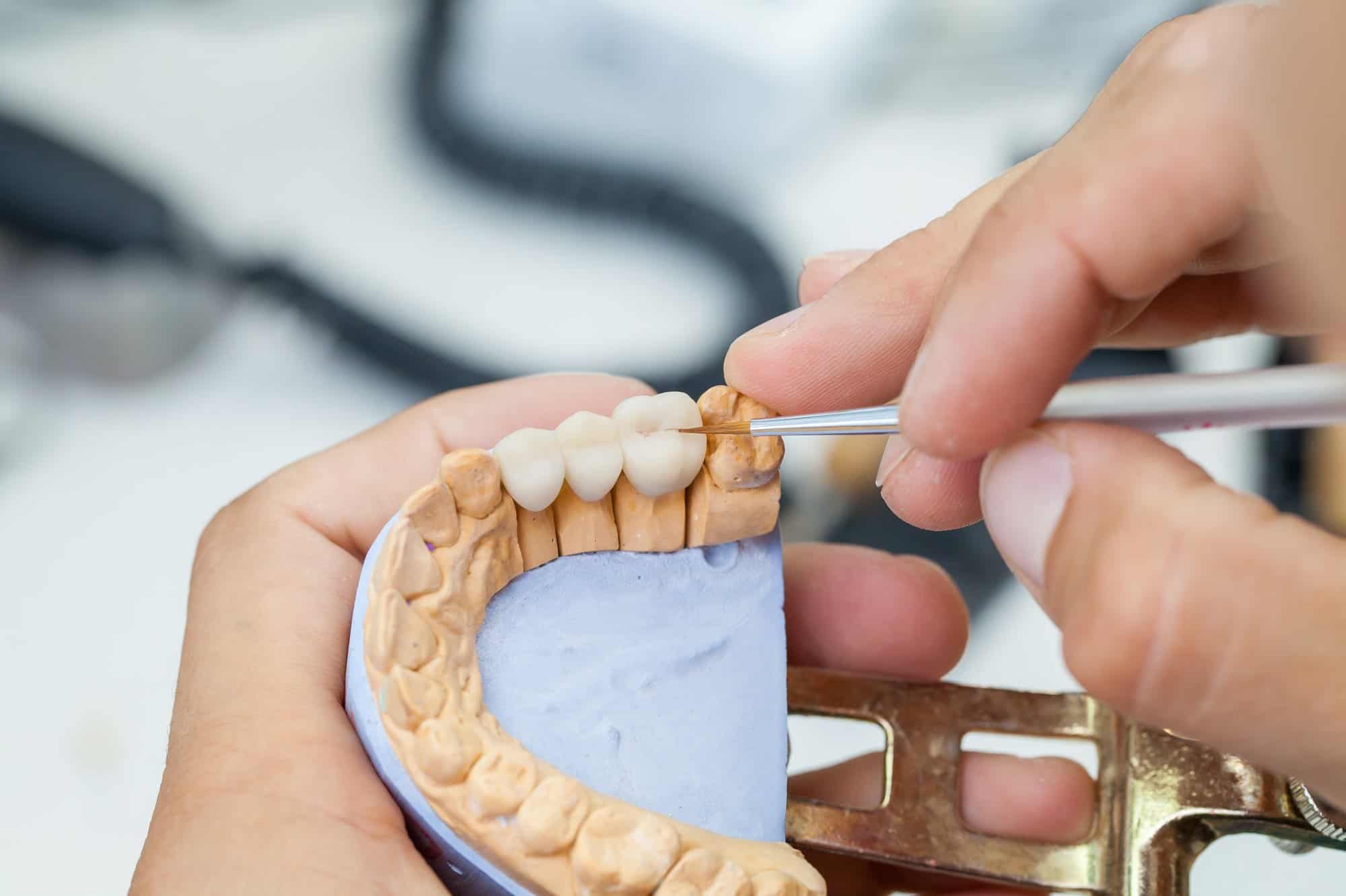 dental bridge fabrication