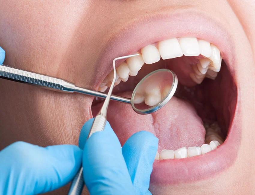 Signs you may need fluoride treatments — Smile Tustin by Dr. Ezzy
