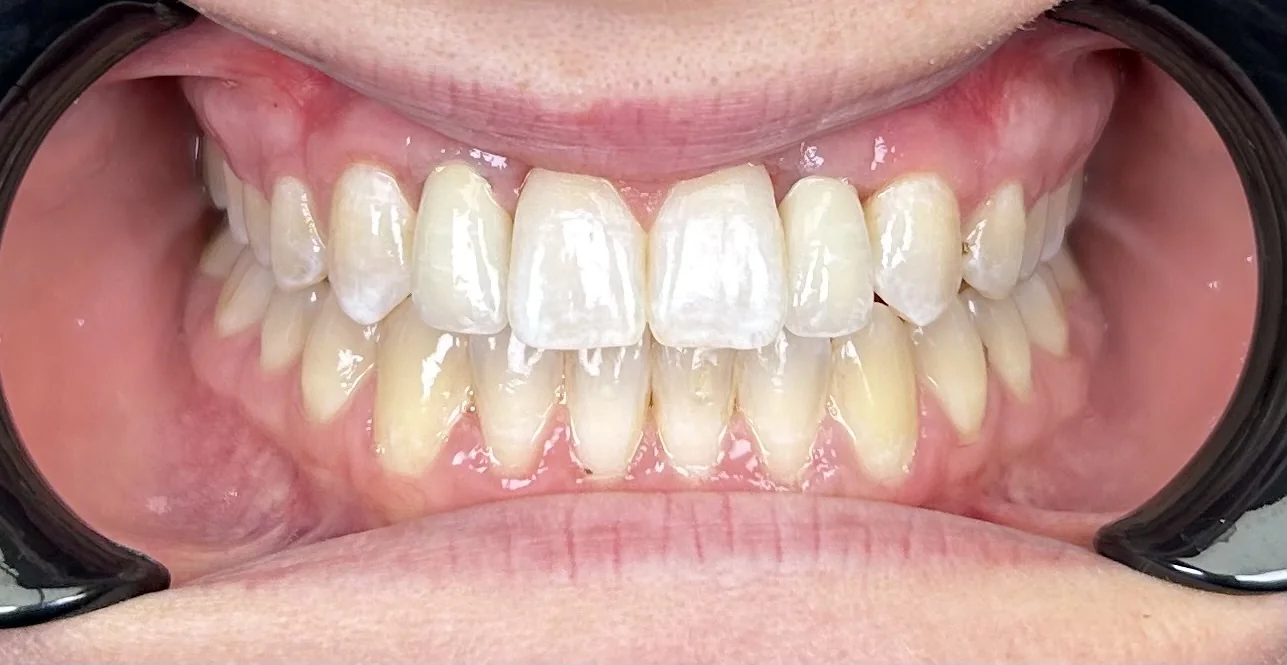 After — Dental Implants — Case 1