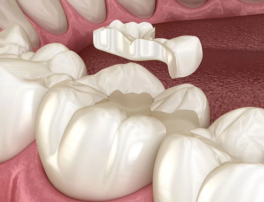 Inlays and Onlays at Smile Tustin by Dr. Ezzy