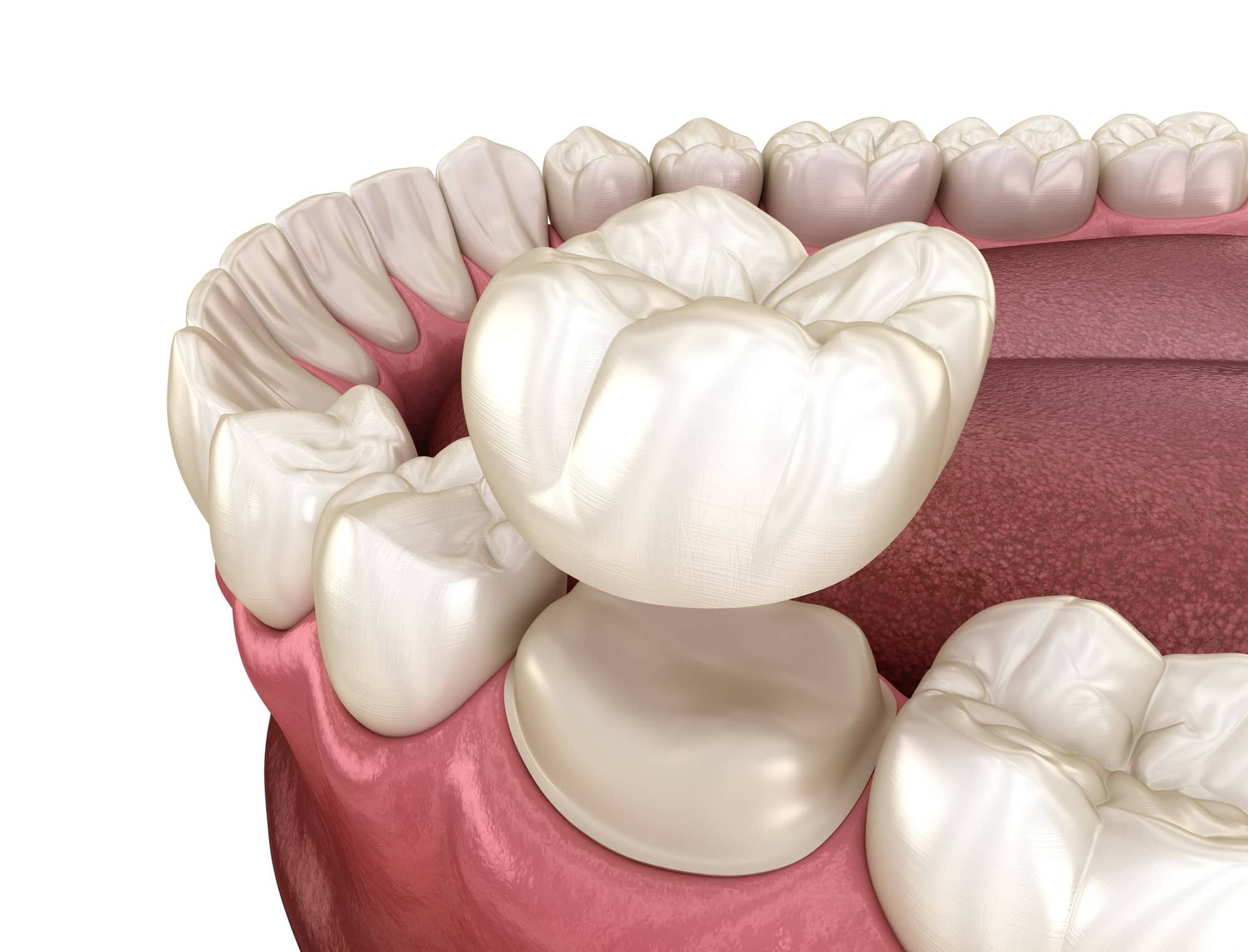How Long Until My New Crown Feels Normal?