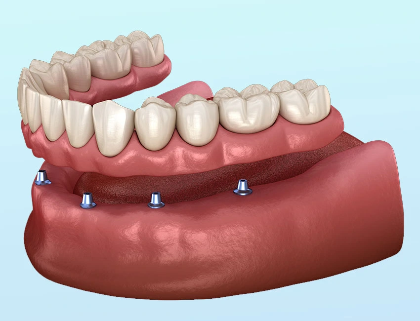 Implant-Supported Dentures at Smile Tustin by Dr. Ezzy