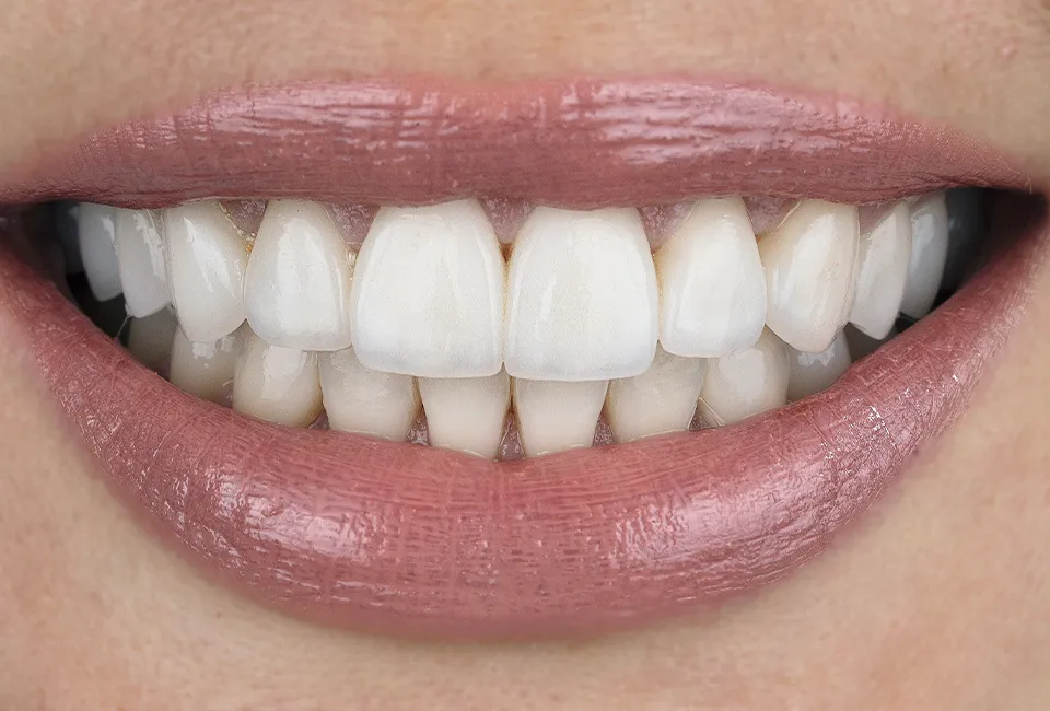 How Can A Dentist Fix a Gap Between Front Teeth