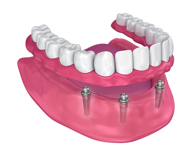 Signs you may need implant-supported dentures — Smile Tustin by Dr. Ezzy