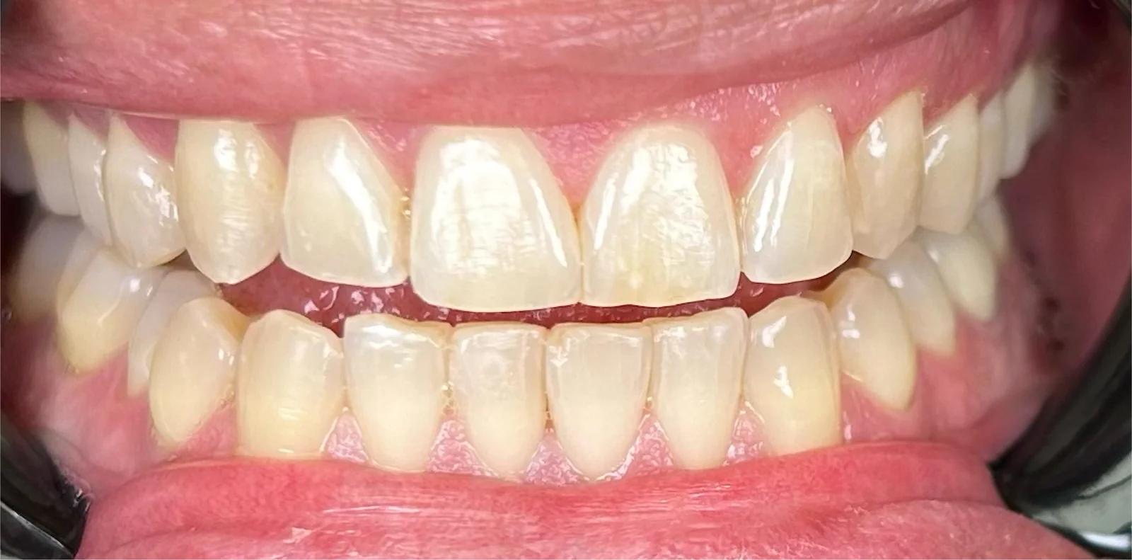 After — Invisalign — Case 2