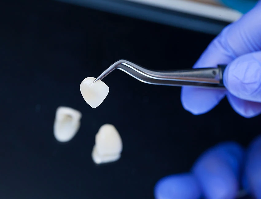 Porcelain Veneers at Smile Tustin by Dr. Ezzy
