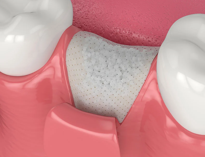 Signs you may need bone grafting — Smile Tustin by Dr. Ezzy