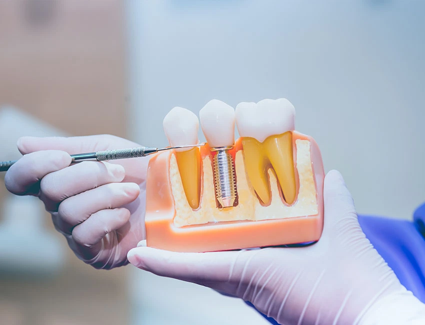 Dental Implants at Smile Tustin by Dr. Ezzy