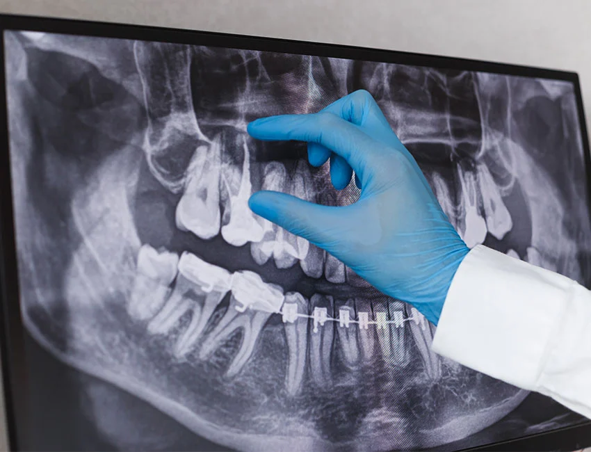 Root Canal Therapy at Smile Tustin by Dr. Ezzy