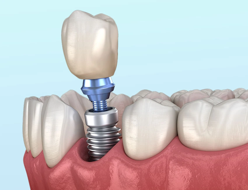 Signs you may need dental implants — Smile Tustin by Dr. Ezzy