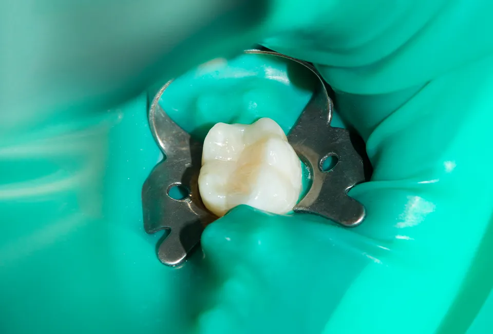 Can a Root Canal Procedure Save Your Tooth in Tustin?