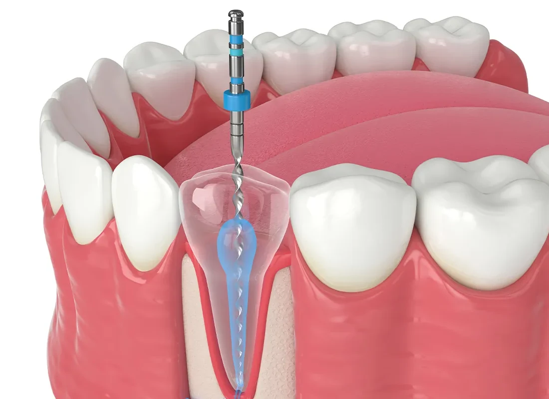 Microscopic Microsurgeries at Smile Tustin by Dr. Ezzy