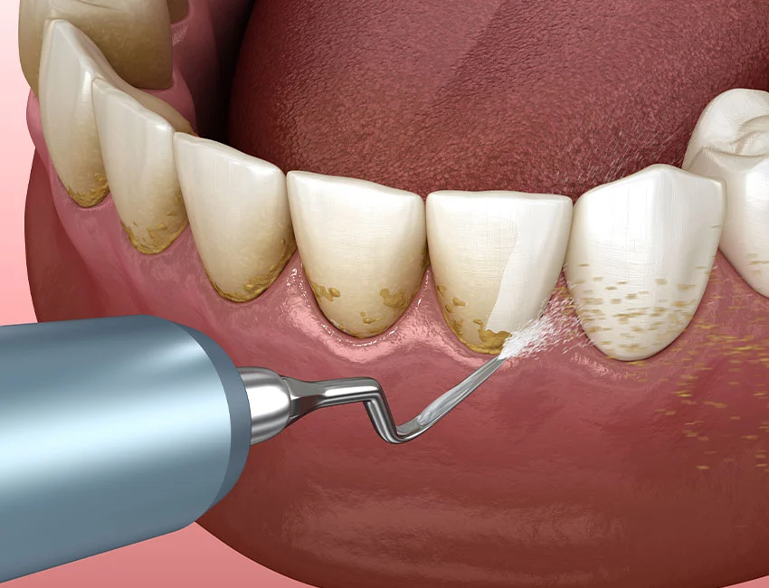 Dental Cleanings (Prophy) at Smile Tustin by Dr. Ezzy